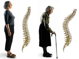 15469 cdf4fdd2 bdb5 46af a7e2 aa084e16f2a1 oesteoporose